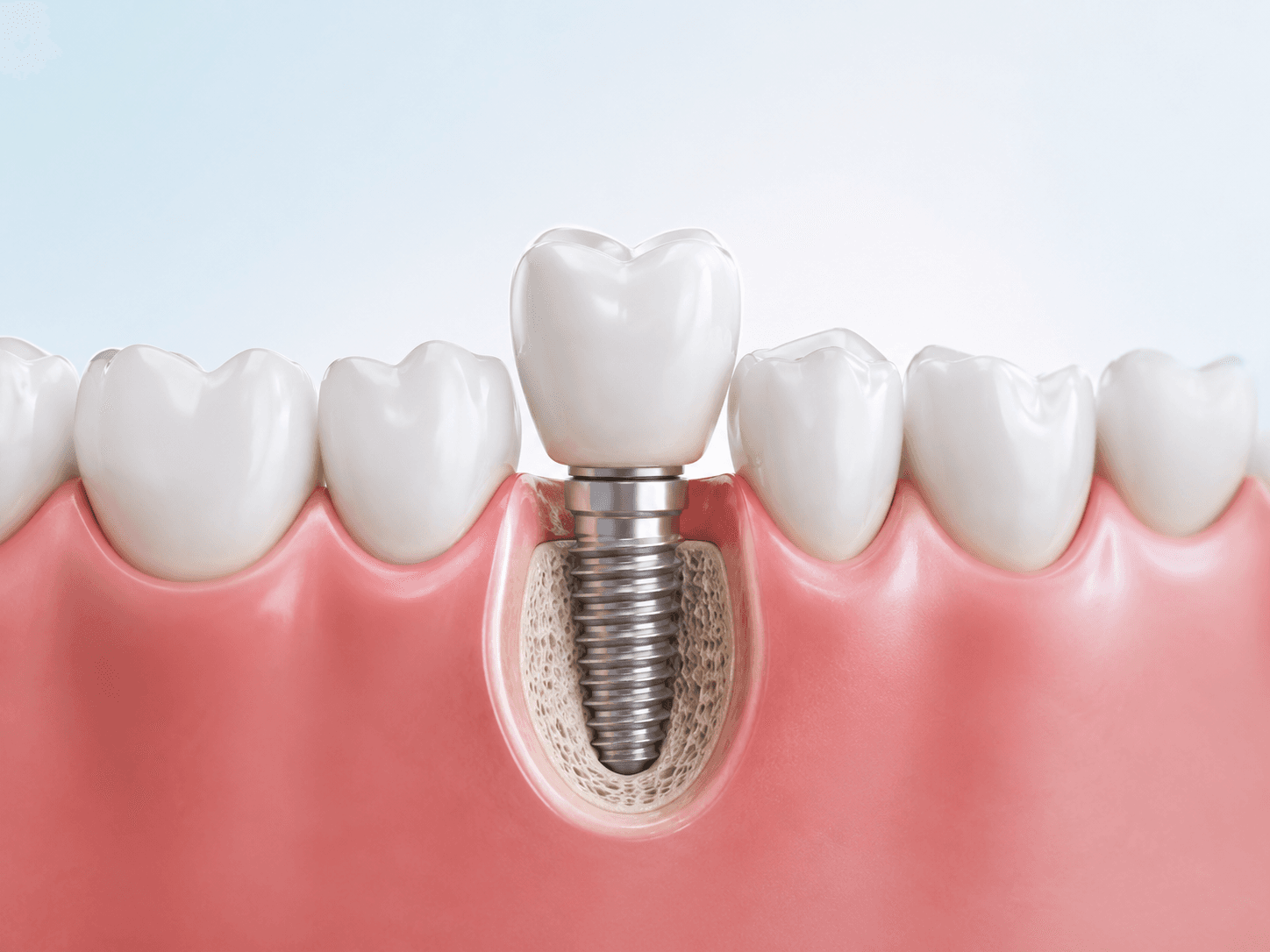 Implante dental